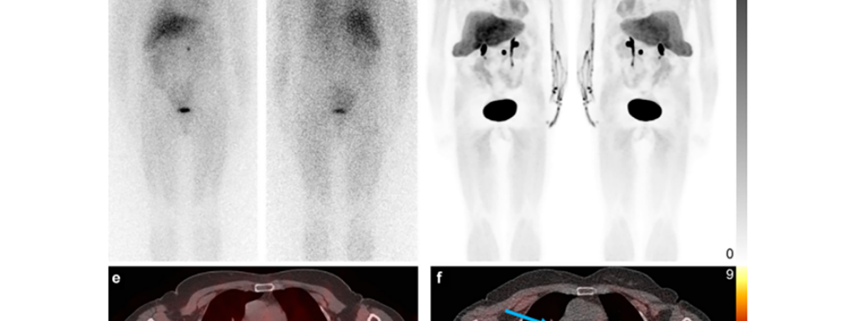 teranostik, radyofarmasötik